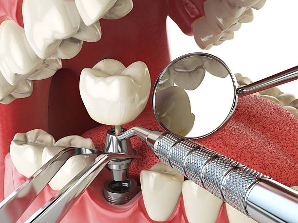 Best Emergency Wisdom Teeth Removal in State Center, IA